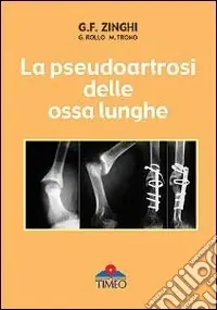 La pseudoartrosi delle ossa lunghe Ultima Occasione